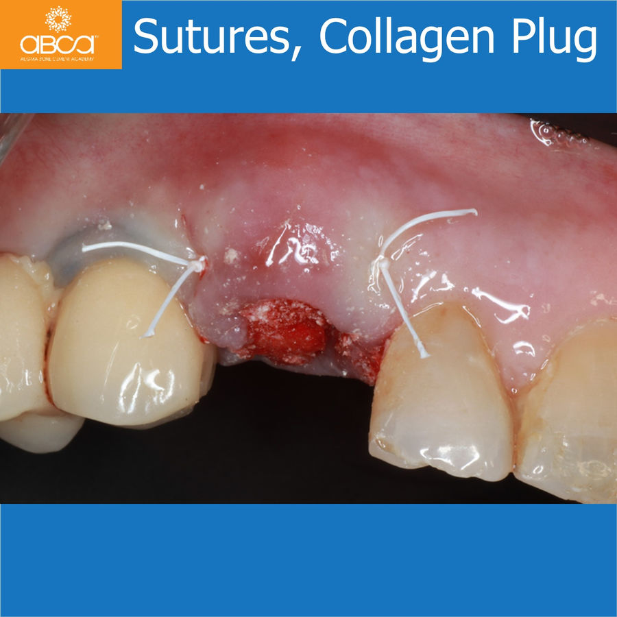 Sutures, Collagen Plug