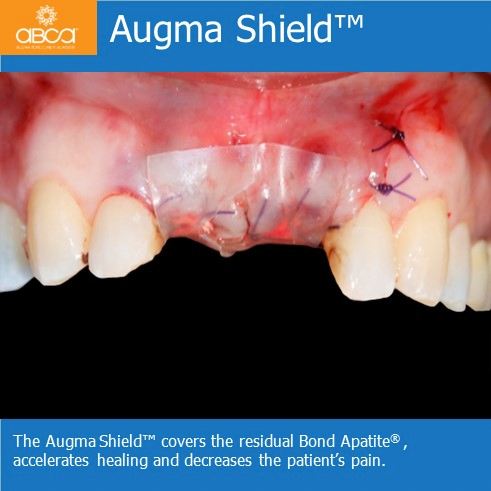 Augma Shield | The Augma Shield covers the residual Bond Apatite, accelerates healing and decreases the patient's pain.
