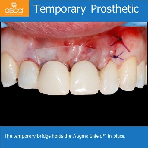 Temporary Prosthetic | The temporary bridge holds the Augma Shield in place.