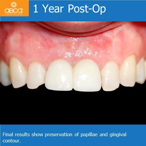 1 Year Post-Op | Final results show preservation of papillae and gingival contour.