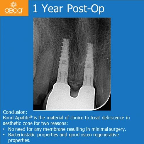 1 Year Post-Op | Conclusion | Bond Apatite is the material of choice to  treat dehiscence in aesthetic zone for two reasons: No need for any membrane resulting in minimal surgery; Bacteriostatic properties and good osteo regenerative properties.