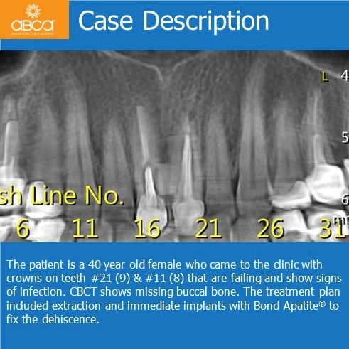 Case Description | The patient is a 40 year old female who came to the clinic with crowns on teeth #21 (9) & #11 (8) that are failing and show signs of infection. CBCT shows missing buccal bone. The treatment plan included extraction and immediate implants with Bond Apatite to fix the dehiscence.