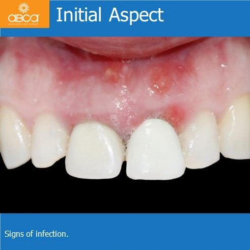 Initial Aspect | Signs of infection.