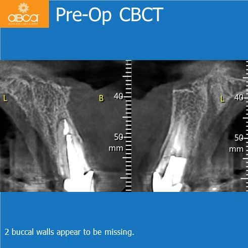 Pre-Op CBCT | 2 buccal walls appear to be missing.