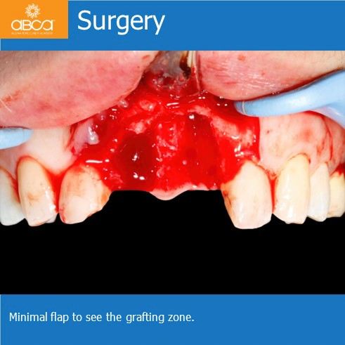 Surgery | Minimal flap to see the grafting zone.