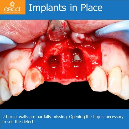 Implants in Place | 2 buccal walls are partially missing. Opening the flap is necessary to see the defect.