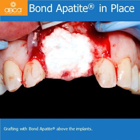 Bond Apatite in Place | Grafting with Bond Apatite above the implants.