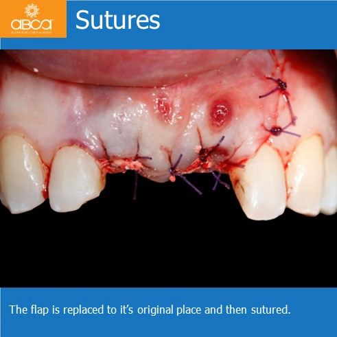 Sutures | The flap is replaced to it's original place and then sutured.