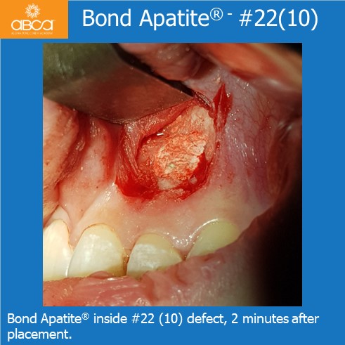 Bond Apatite® inside #22 (10) defect, 2 minutes after placement.