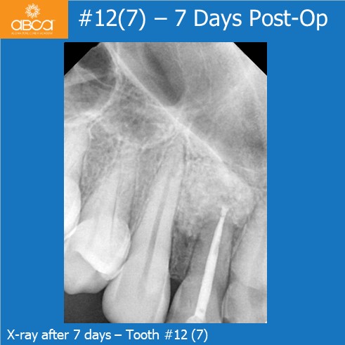 #12(7) - 7 Days Post-Op | X-ray after 7 days - Tooth #12 (7)