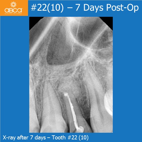 X-ray after 7 days - Tooth #22 (10)
