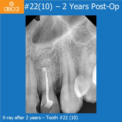 X-ray after 2 years - Tooth #22 (10)