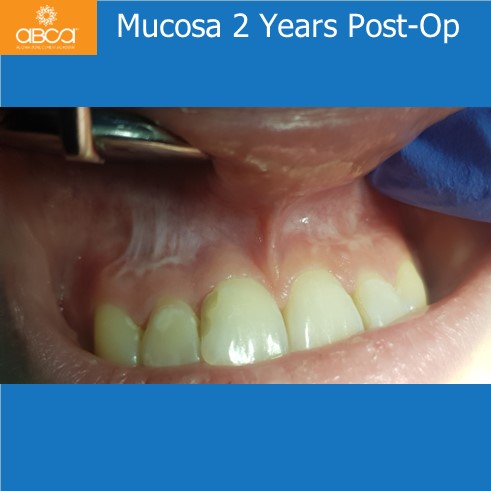 Mucosa 2 Years Post-Op
