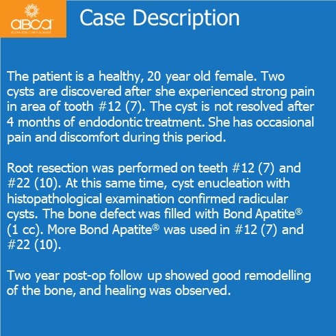 Case Description | The patient is a healthy, 20 year old female. Two cysts are discovered after she experienced strong pain in area of tooth # 12 (7). The cyst is not resolved after 4 months of endodontic treatment. She has occasional pain and discomfort during this period. Root resection was performed on teeth #12 (7) and #22 (10). At this same time, cyst enucleation with histopathological examination confirmed radicular cysts. The bone defect was filled with Bond Apatite® (1 cc). More Bond Apatite® was used in #12 (7) and #22 (10). Two year post-op follow up showed good remodelling of the bone, and healing was observed.