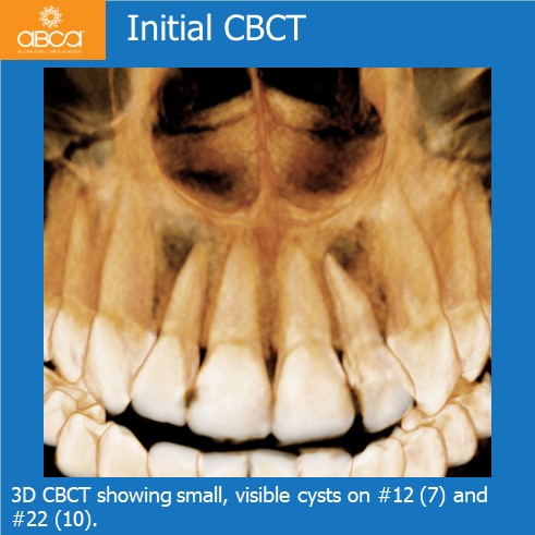 Initial CBC | 3D CBCT showing small, visible cysts on #12 (7) and #22 (10).