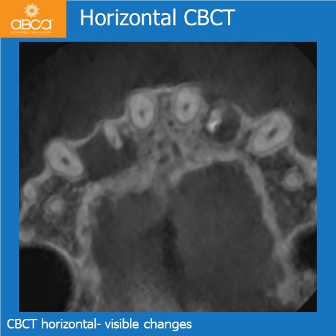 Horizontal CBCT | CBCT horizontal- visible changes