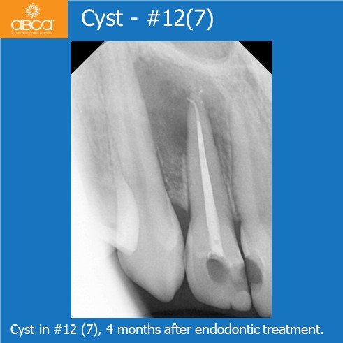 Cyst in # 12 (7), 4 months after endodontic treatment.