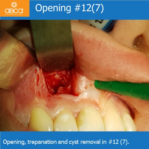 Opening #12(7) | Opening, trepanation and cyst removal in #12 (7).