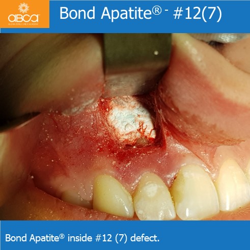 Bond Apatite® inside #12 (7) defect.