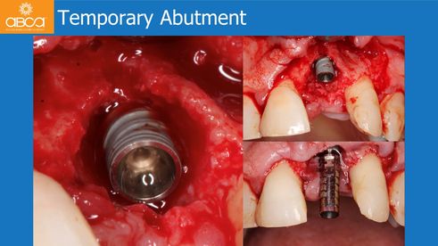 Temporary Abutment