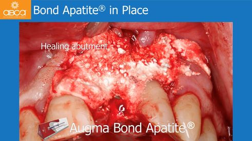 Bond Apatite® in Place