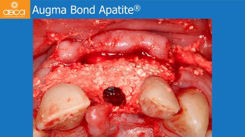 Augma Bond ApatiteŽ