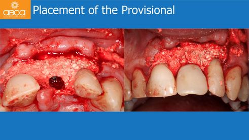 Placement of the Provisional