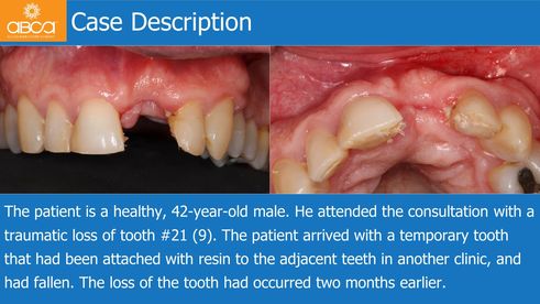 Case Description | The patient is a healthy, 42-year-old male. He attended the consultation with a traumatic loss of tooth #21 (9). The patient arrived with a temporary tooth that had been attached with resin to the adjacent teeth in another clinic, and had fallen. The loss of the tooth had occurred two months earlier.