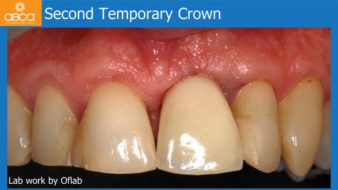 Second Temporary Crown