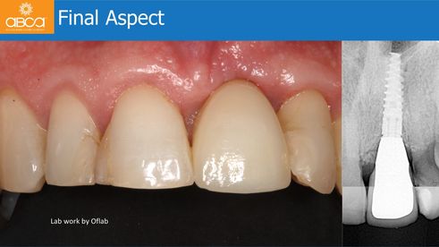 Final Aspect