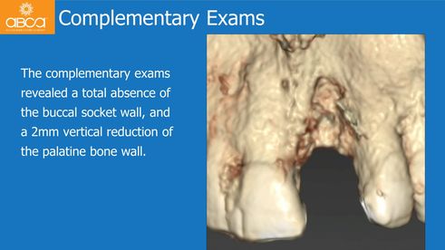 Complementary Exams | The complementary exams revealed a total absence of the buccal socket wall, and a 2mm vertical reduction of the palatine bone wall.