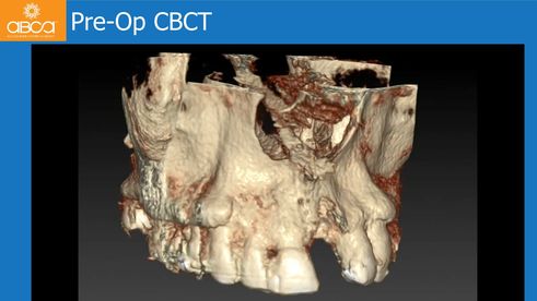 Pre-Op CBCT