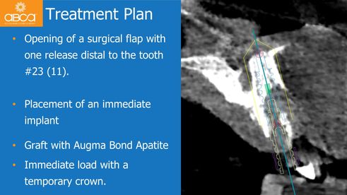 Treatment Plan | Opening of a surgical flap with one release distal to the tooth #23 (11). Placement of an immediate implant; Graft with Augma Bond Apatite; Immediate load with a temporary crown.