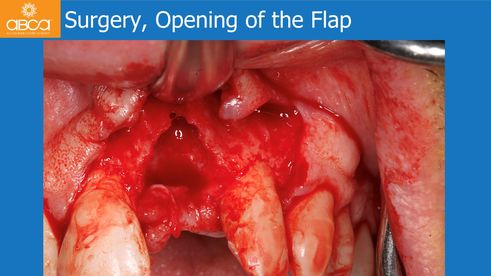 Surgery, Opening of the Flap