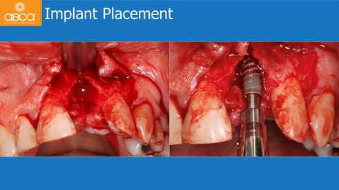 Implant Placement