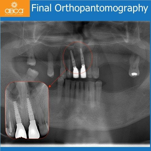 Final Orthopantomography