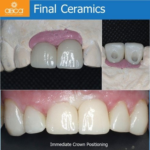 Final Ceramics - Immediate Crown Positioning