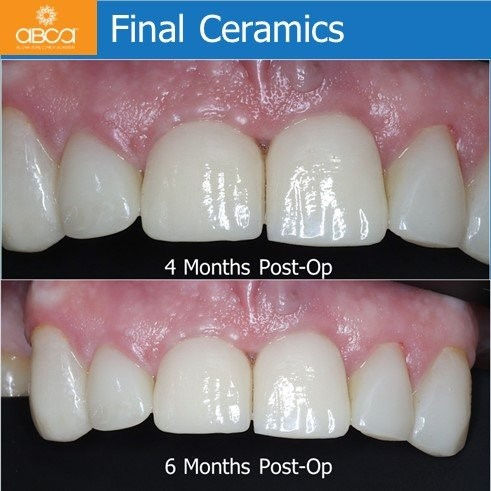 Final Ceramics - 4 Months & 6 Months Post-Op