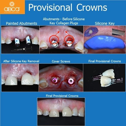 Provisional Crowns