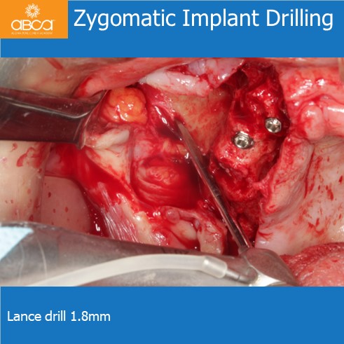 Zygomatic Implant Drilling | Lance drill 1.8mm