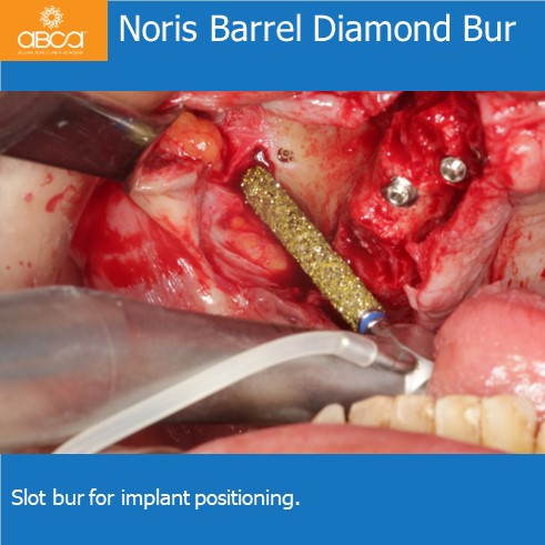 Noris Barrel Diamond Bur | Slot bur for implant positioning.