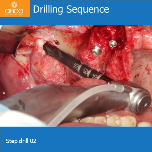 Drilling Sequence | Step drill 02