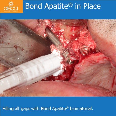 Bond ApatiteŽ in Place | Filling all gaps with Bond ApatiteŽ biomaterial.