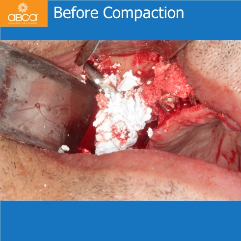 Before Compaction