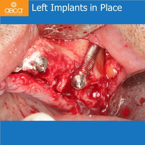 Left Implants in Place