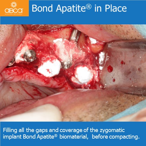 Bond ApatiteŽ in Place | Filling all the gaps and coverage of the zygomatic implant Bond ApatiteŽ biomaterial, before compacting.