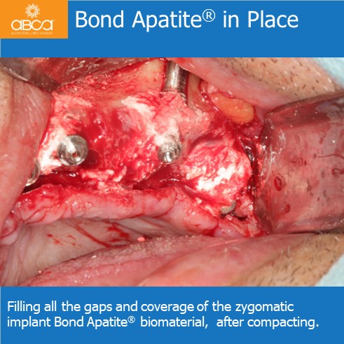 Bond Apatite® in Place | Filling all the gaps and coverage of the zygomatic implant Bond Apatite® biomaterial, after compacting.