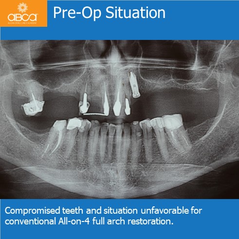 Pre-Op Situation | Compromised teeth and situation unfavorable for conventional All-on-4 full arch restoration.