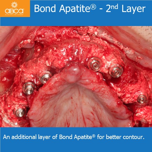 Bond Apatite® - 2nd Layer | An additional layer of Bond Apatite® for better contour.