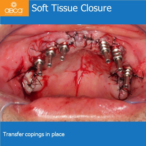 Soft Tissue Closure | Transfer copings in place